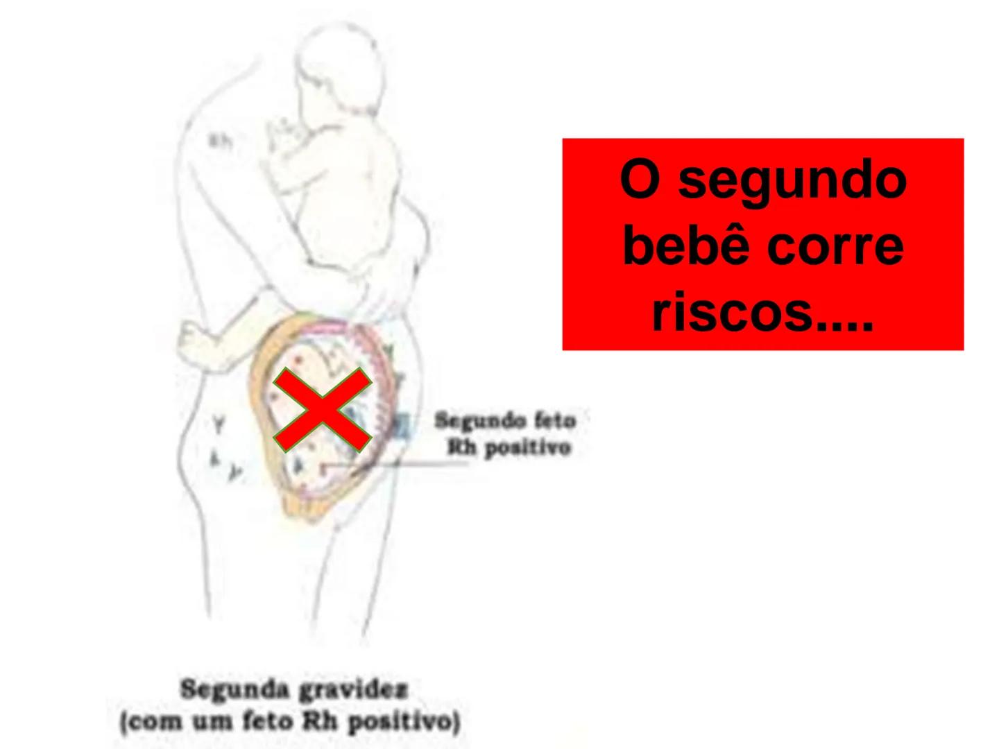 # Tipos sanguíneos e Eritroblastose
Fetal # Sistema ABO - alelos múltiples # A descoberta dos grupos sanguíneos
- Estudado em 1900pelo médi