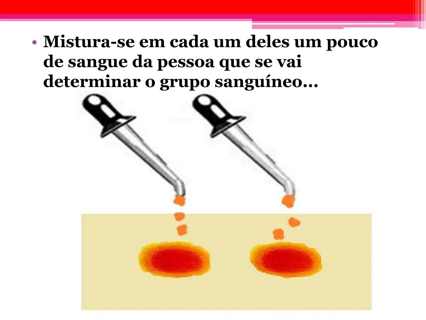# Tipos sanguíneos e Eritroblastose
Fetal # Sistema ABO - alelos múltiples # A descoberta dos grupos sanguíneos
- Estudado em 1900pelo médi