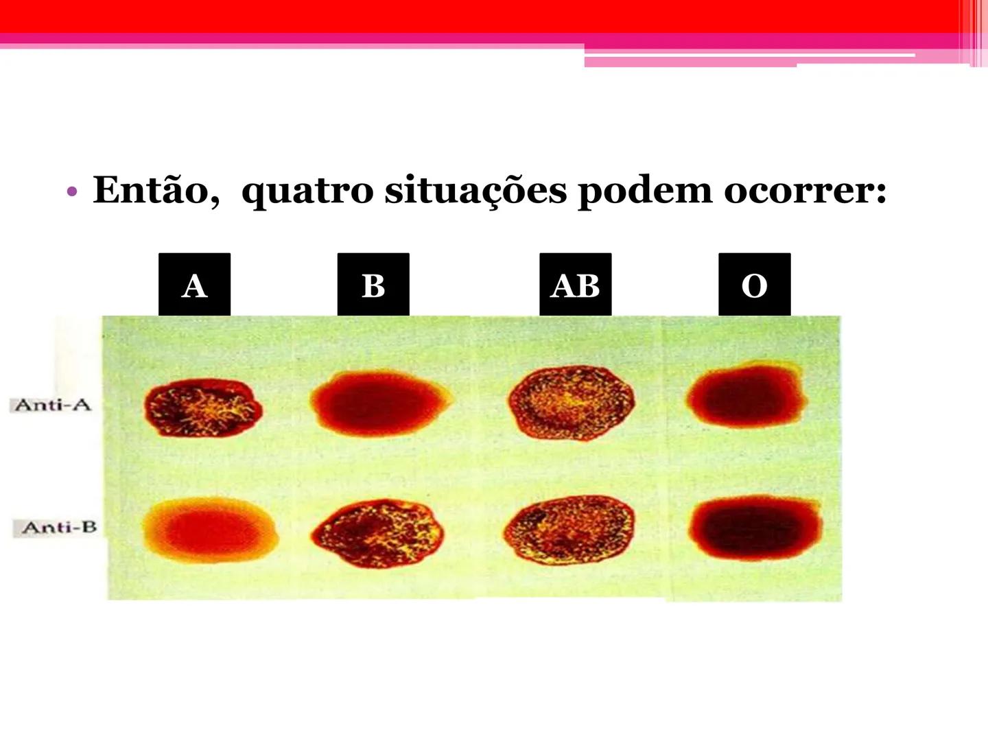 # Tipos sanguíneos e Eritroblastose
Fetal # Sistema ABO - alelos múltiples # A descoberta dos grupos sanguíneos
- Estudado em 1900pelo médi