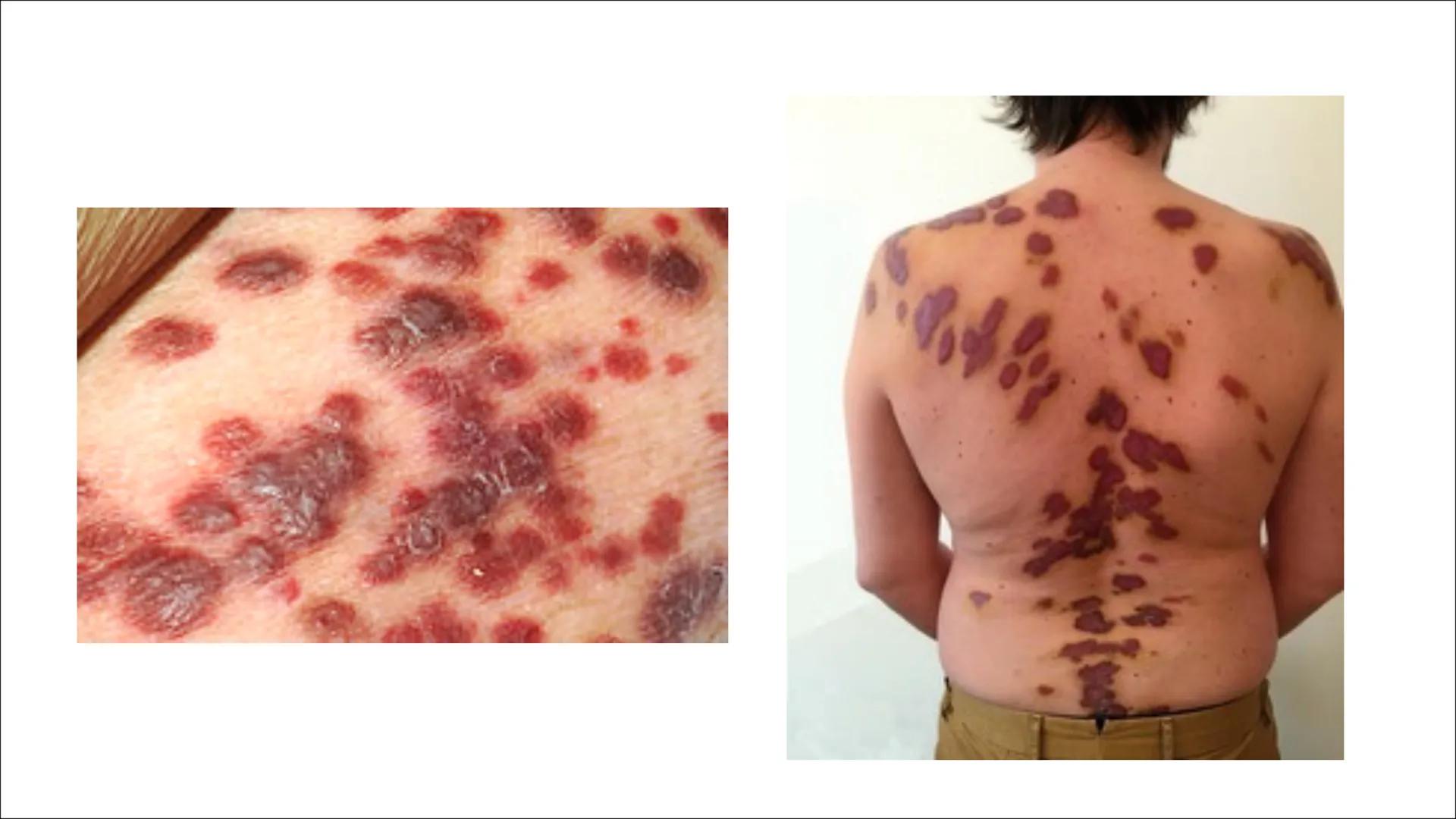 AIDS
& Gliederung:
1. Definition
2. Das HI-Virus
2.1 Allgemeines
2.2 Entdeckung
2.3 Wie schwächt es das Immunsystem?
2.4 HIV Typ 1 und 2
Ver